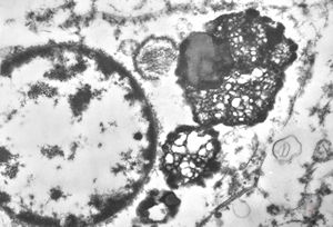 M,46y. | prostate - residual lysosomes M,46y. | prostate - residual lysosomes